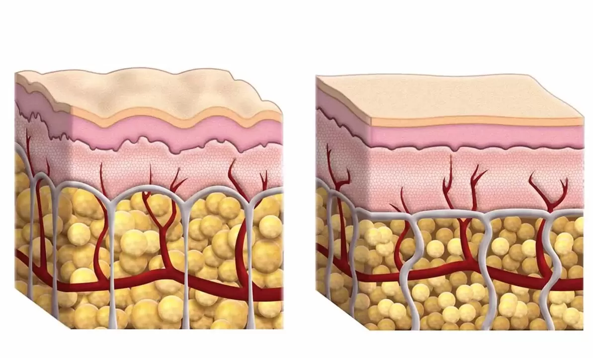 Células grasas mientras usa Keto Guru