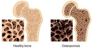 osteoporosis de huesos